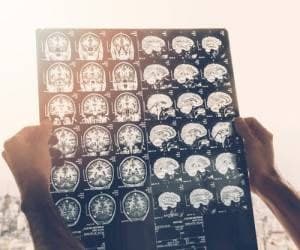 سوال 8 بیماری های مغز و اعصاب آزمون دستیاری پزشکی 1400